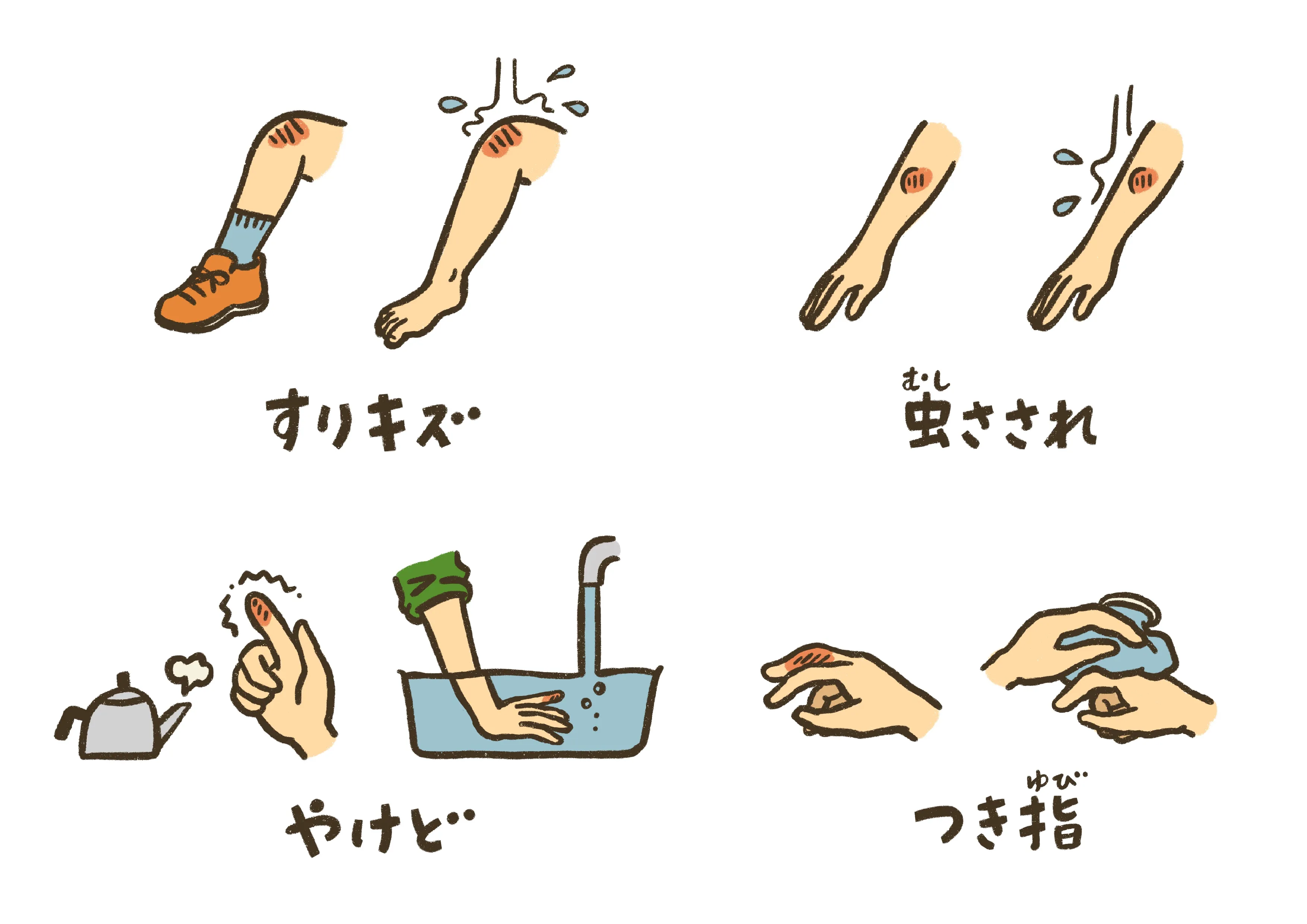 骨折や肉離れの直後に冷却と固定を行う応急対応のイラスト